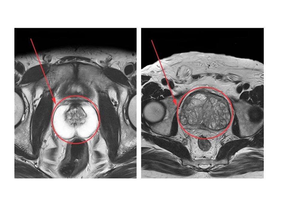 Comparison between a healthy (left) and an inflamed (right) prostate on MRI images